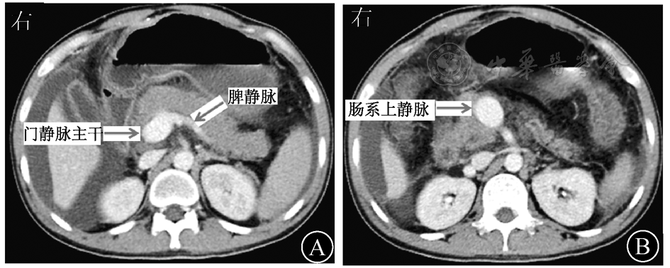 外伤后肠系膜上动静脉瘘致区域性门静脉高压一例