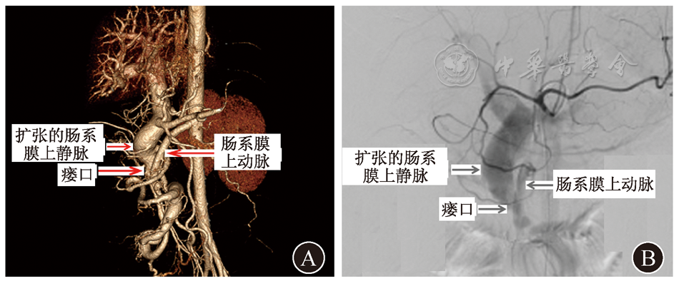 静脉交通支形成  a 门静脉及腹主动脉血管三维重建  b 肠系膜上动脉