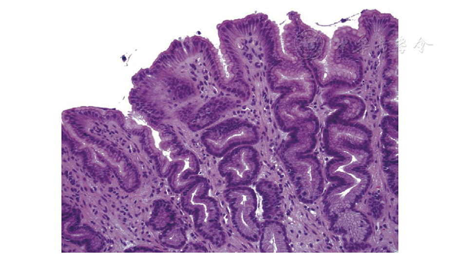 点击查看大图 图3 胆汁反流性胃病患者胃黏膜组织学表现,可见胃小凹