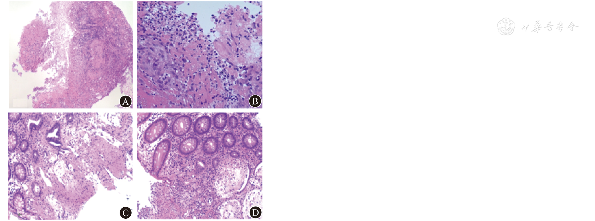 40 b 回肠末段溃疡坏死和周围上皮样组织细胞反应×200 c 降结肠