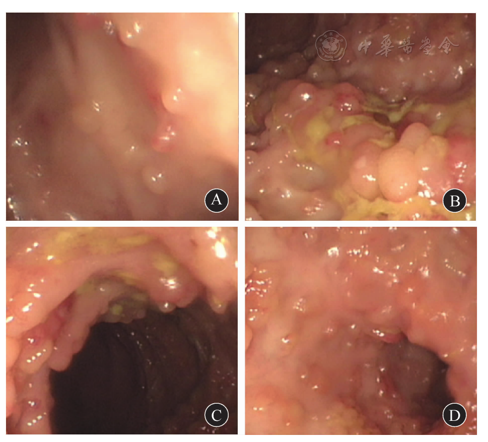 a 直肠充血,水肿,散在假性息肉形成 b 乙状结肠充血,水肿,溃疡,瘢痕和