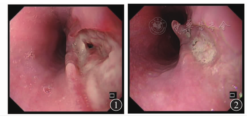 图1 2017年7月18日胃镜检查示:食管后壁距离门齿约30 cm处见一较深
