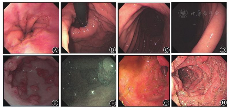 十二指肠球部和降部黏膜多发桑葚样息肉样隆起,充血明显  a 齿状线