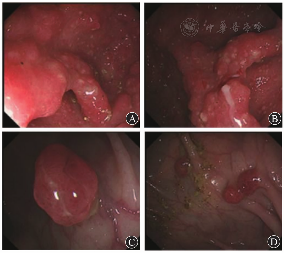 可见多发增生性息肉并伴有白色囊泡样结构,活组织检查过程中有白色脓