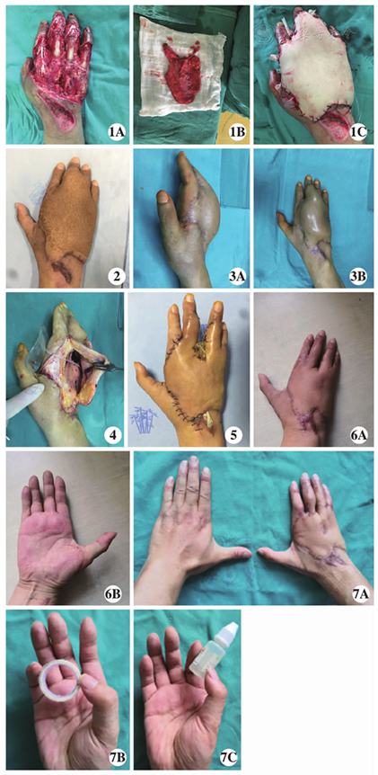 皮肤扩张器治疗皮瓣术后虎口挛缩一例
