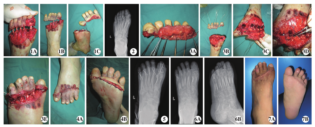 左足5趾完全离断伤再植成活一例
