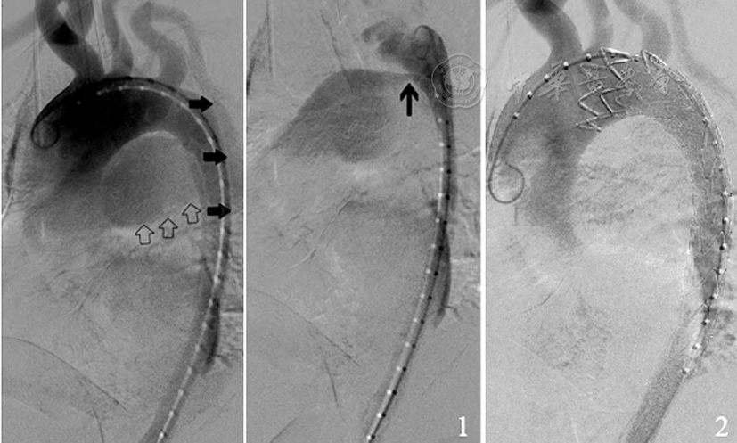 腔内隔绝术治疗1例stanfordb型主动脉夹层合并动脉导管未闭
