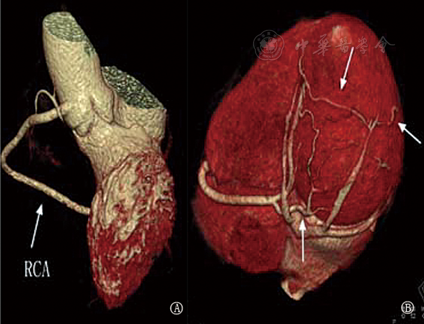 先天性左冠状动脉缺如单支冠状动脉畸形1例