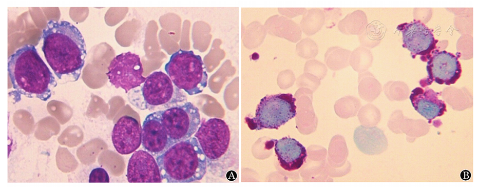 a:骨髓涂片(瑞氏染色,×1 000);b:骨髓细胞的pas染色(×1 000)