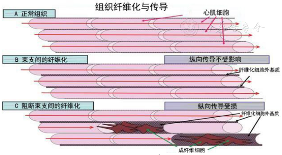 点击查看大图 图4 组织纤维化对心肌细胞(红色细胞)束传导的预期效果