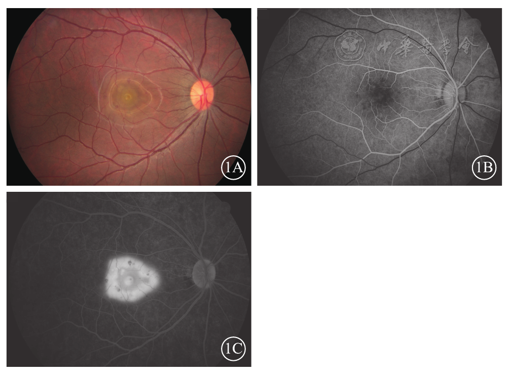 单侧急性特发性黄斑病变一例 - 中华眼底病杂志