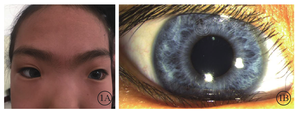 右眼眼前节像,虹膜色素脱失呈灰白色,虹膜基质萎缩