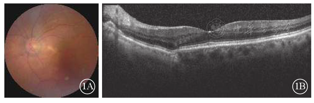 光相干断层扫描观察局限性脉络膜凹陷继发脉络膜新生血管一例