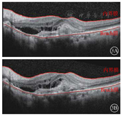 光相干断层扫描观察局限性脉络膜凹陷继发脉络膜新生血管一例