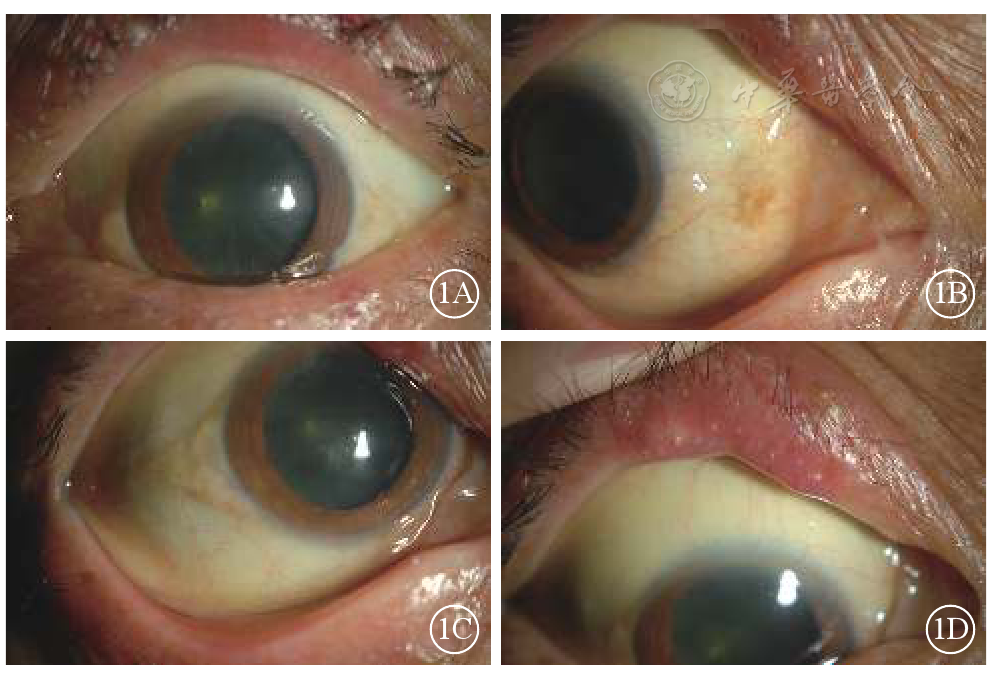 鼻侧对称分布的睑裂斑,球结膜色偏黄;1d示右眼上睑睑板腺管部分阻塞
