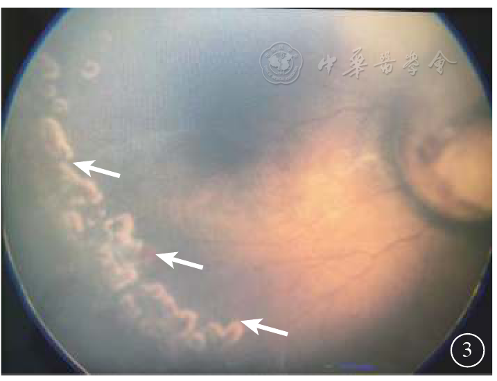 牵牛花综合征合并永存原始玻璃体增生症伴早产儿视网膜病变一例