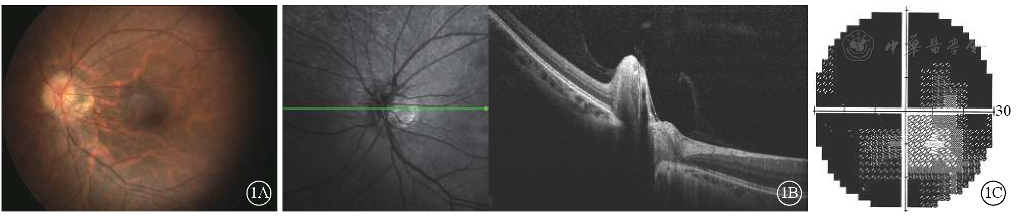 可见视盘鼻侧神经纤维层增厚.1c示