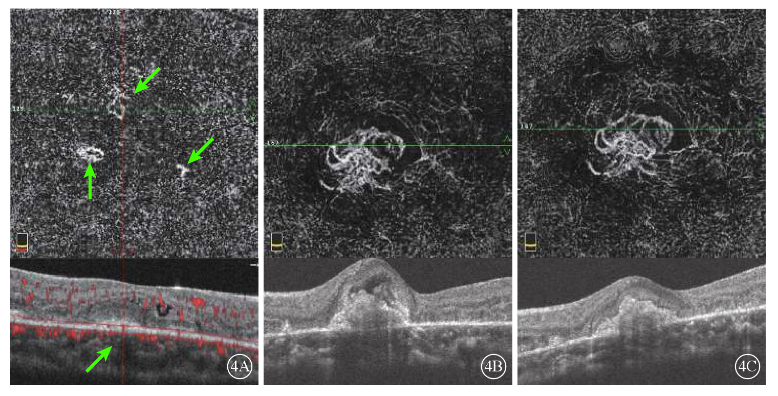青少年双眼特发性中心凹旁毛细血管扩张症继发双眼脉络膜新生血管一例