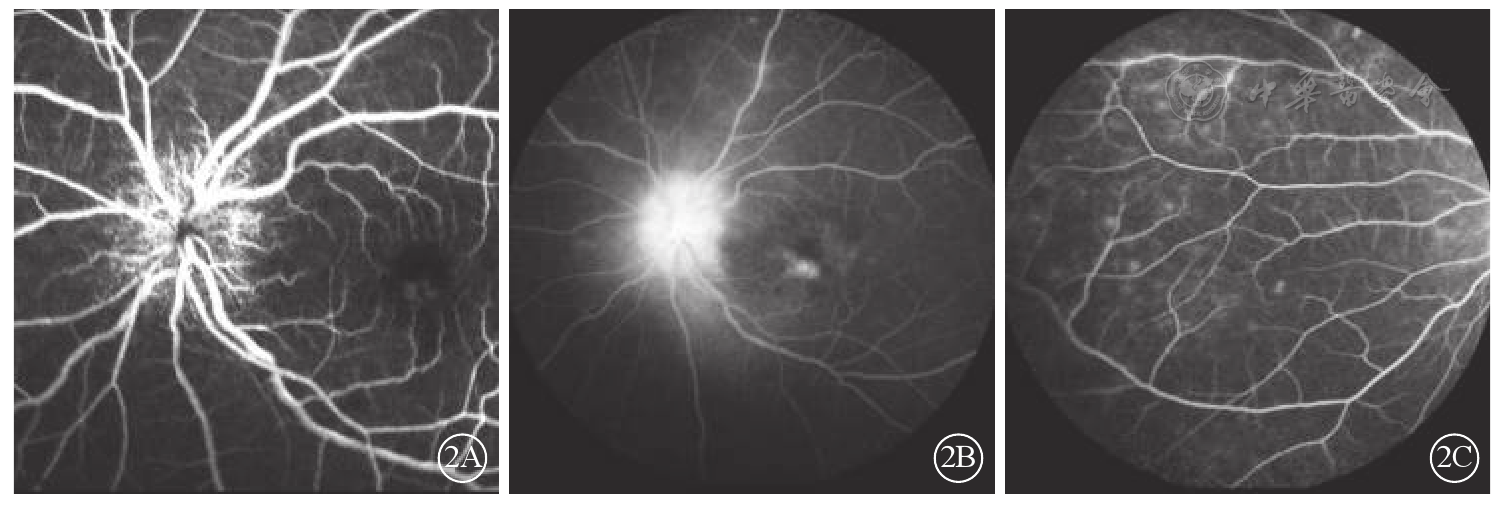 视盘毛细血管扩张,黄斑区出血遮蔽荧光;2b示晚期,视盘荧光素渗漏,边界
