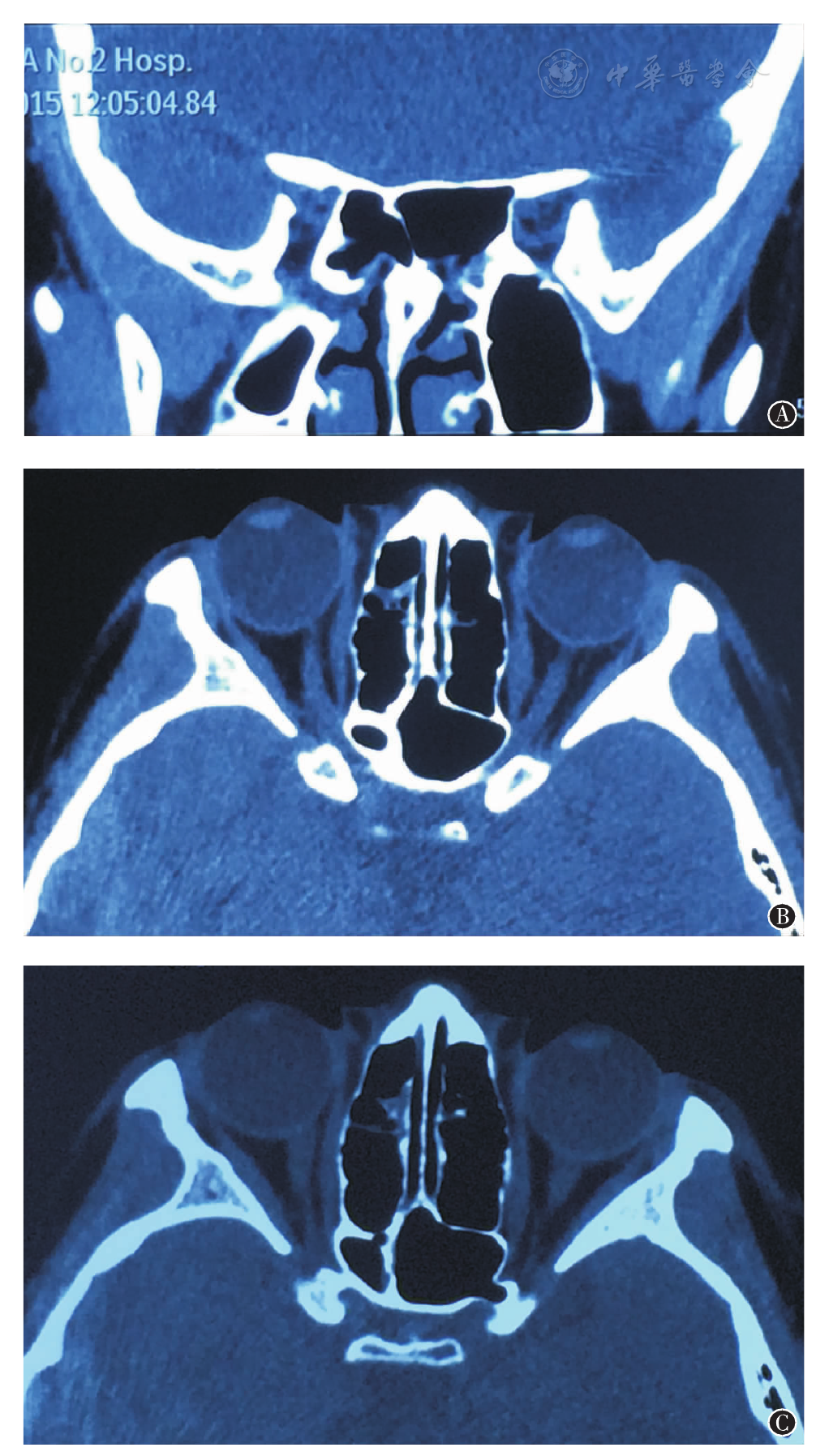 点击查看大图 图1 外伤性视神经病变患者术前眼眶ct图像