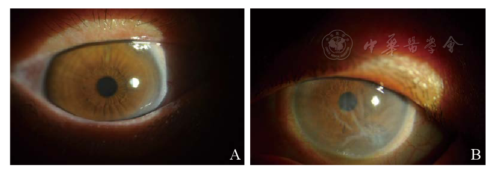 虹膜激光周切术后角膜内皮失代偿修复一例