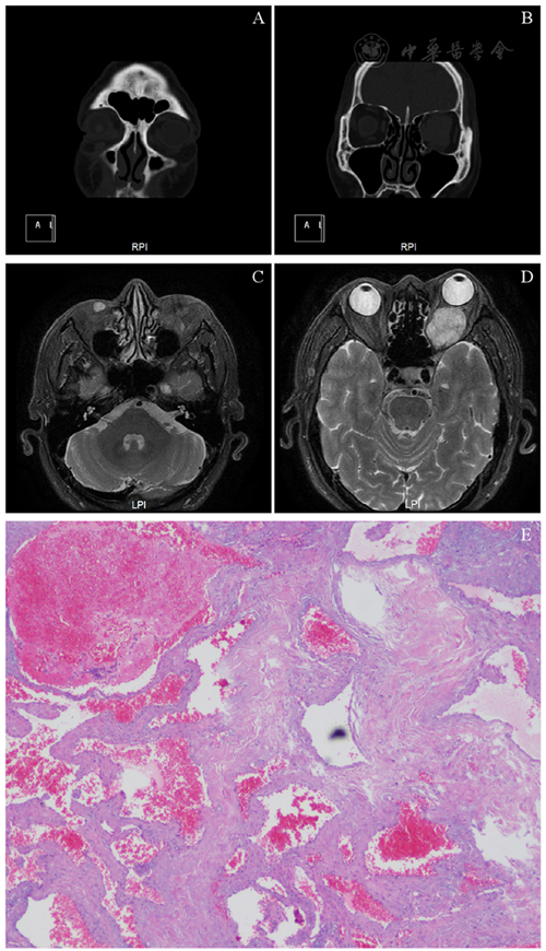双侧眼眶海绵状血管瘤一例