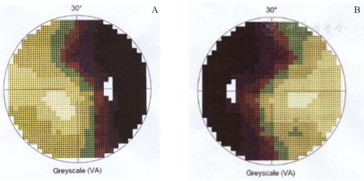 双眼鼻侧视网膜病变所致双颞侧视野缺损四例