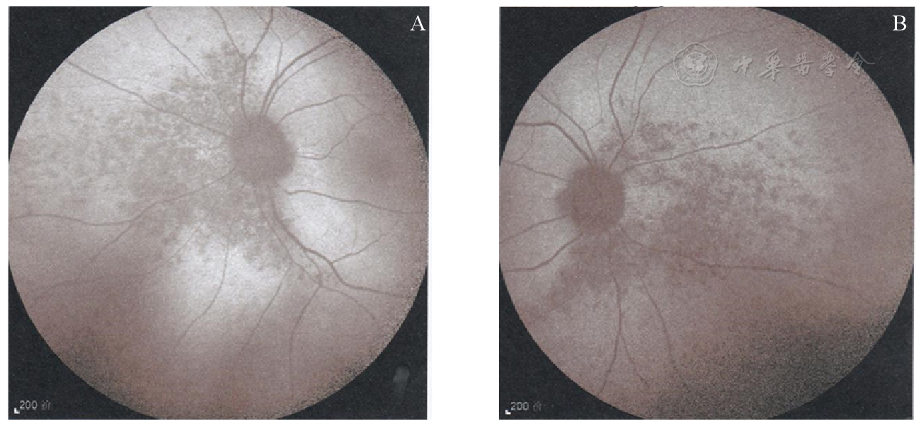 双眼鼻侧视网膜病变所致双颞侧视野缺损四例