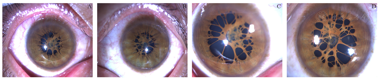 成人先天性瞳孔残膜伴高度远视及短眼轴一例