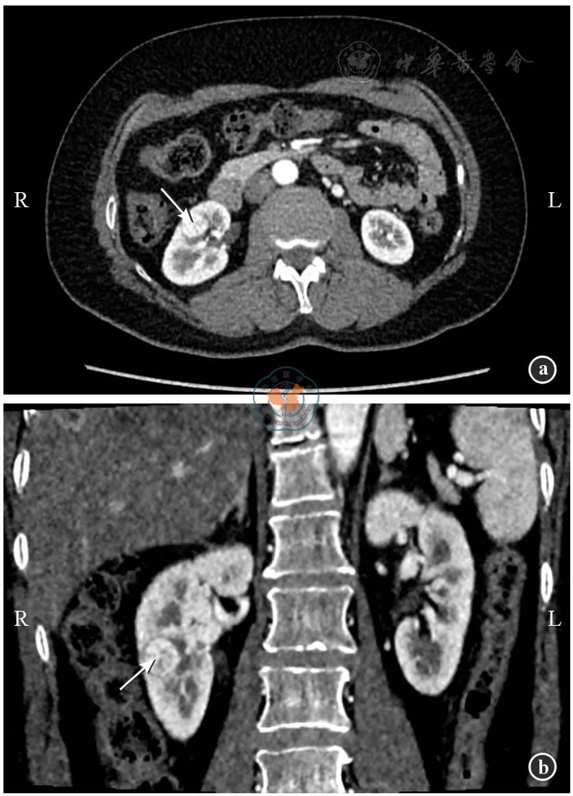 图1 亲属活体供肾小肾癌切除后肾移植供者供肾切取术前肾脏ct血管造影
