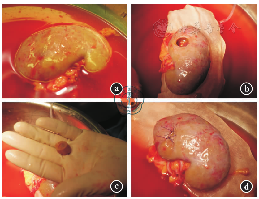 亲属活体供肾小肾癌切除后肾移植一例并文献复习