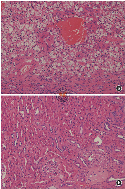 图5 亲属活体供肾小肾癌切除后肾移植供肾肿瘤及正常组织术后病理检查