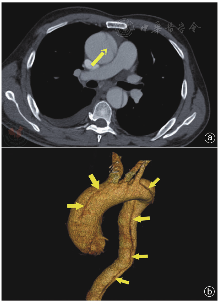 点击查看大图 图4 疑似主动脉瓣脱垂患者胸部ct图像.