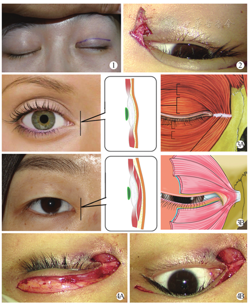重睑联合内眦赘皮矫正术的技术要点