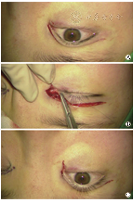 重睑联合内眦赘皮矫正术的技术要点