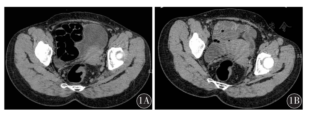 点击查看大图 图1 直肠癌患者新辅助治疗前后ct检查结果