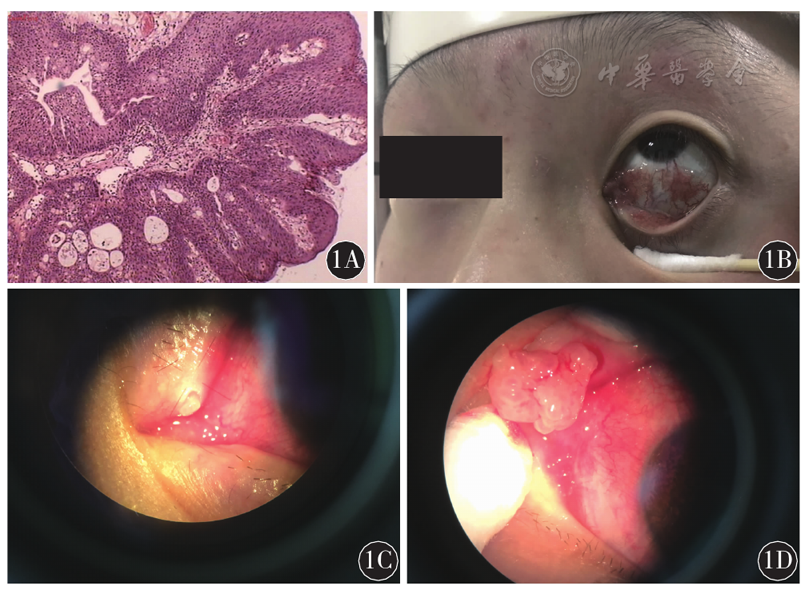 外观及手术显微镜观察结果1a:病理检查提示结膜上皮乳头状增生,伴明显