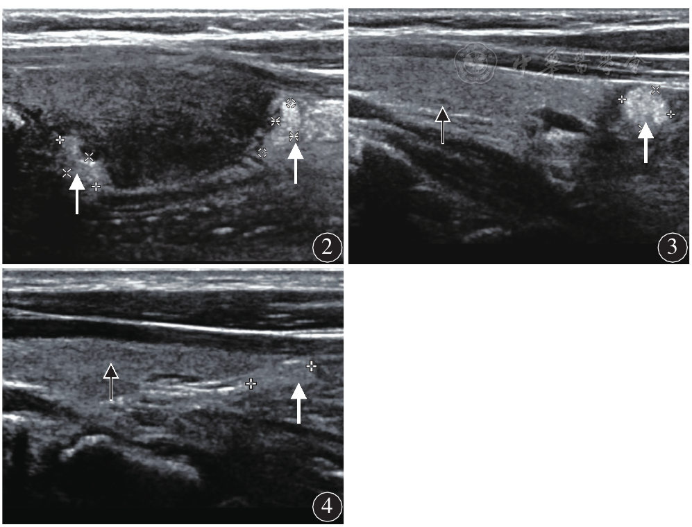 正常甲状腺腺体(黑色箭头)的椭圆形正常甲状旁腺(白色箭头)超声图像