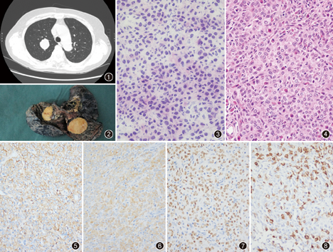 肺嗜酸细胞类癌一例