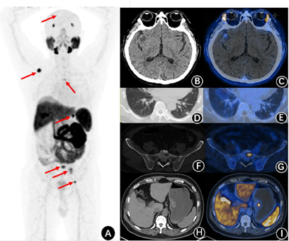 18F-PSMA-1007 PET/CT对肾透明细胞癌胃转移的精准分期及疗效评价 - 中国临床案例成果数据库
