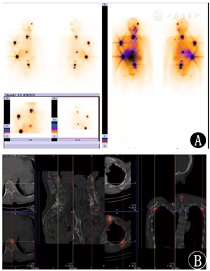 甲状腺滤泡癌伴全身广泛骨转移一例 - 中国临床案例成果数据库