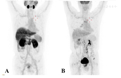 前列腺小细胞神经内分泌癌18F-PSMA-1007 PET/CT显像阴性18F-FDG PET/CT显像阳性一例 - 中国临床案例成果数据库