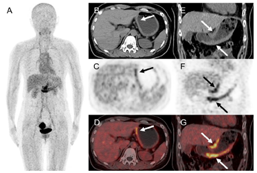 胃印戒细胞癌68Ga-FAPI PET/CT显像一例 - 中国临床案例成果数据库