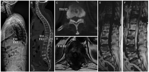 Occult Andersson lesions in patients with ankylosing spondylitis ...