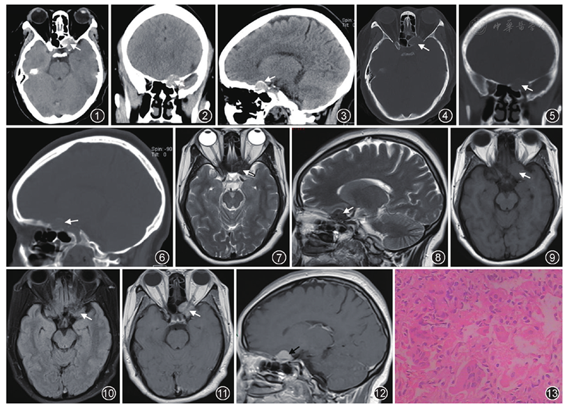 蝶骨骨母细胞瘤一例误诊分析 - 中华放射学杂志