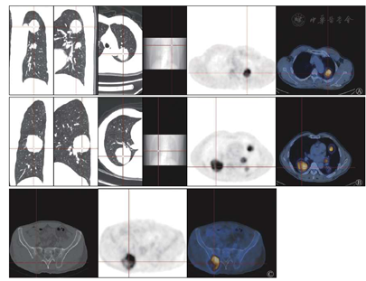 多发肺孤立性纤维瘤增强CT和18F-FDG PET/CT显像一例 - 国际放射医学核医学杂志
