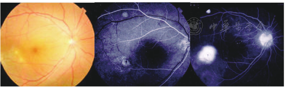 中心性浆液性脉络膜视网膜病变误诊1例