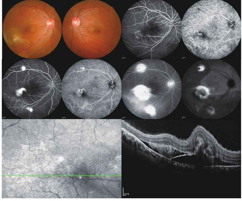 中心性浆液性脉络膜视网膜病变误诊1例