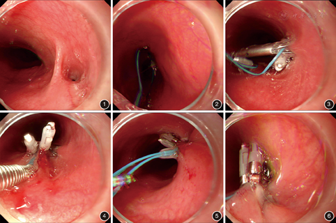 改良荷包缝合术治疗食管气管瘘三例 - 中华消化内镜杂志
