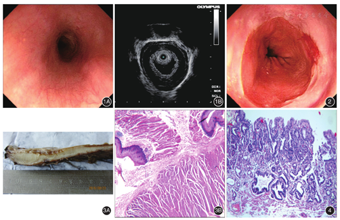 食管环周肌肉肥厚伴贲门黏膜内腺癌一例